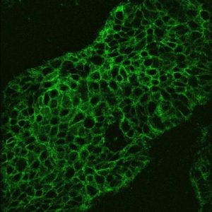 Fluoriszierende Krebszellen